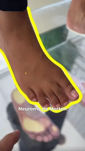 O neuroma de Morton, também conhecido como neuroma interdigital, é uma condição dolorosa que afeta os nervos dos pés, mais comumente entre o terceiro e o quarto dedos. Esse problema ocorre quando o tecido ao redor de um nervo no pé se torna espesso e inflamado, causando dor, formigamento, queimação ou sensação de choque elétrico nos dedos afetados. O tratamento para o neuroma de Morton pode incluir várias abordagens, como: 1. **Palmilhas ortopédicas:** Palmilhas sob medida podem ser usadas para fornecer suporte adequado ao arco do pé, redistribuir a pressão e aliviar a tensão nos nervos. Isso pode ajudar a reduzir a irritação do neuroma e aliviar os sintomas. 2. **Calçados adequados:** Sapatos com biqueira larga e espaço suficiente para os dedos dos pés podem reduzir a pressão sobre a área afetada, proporcionando alívio. 3. **Medicamentos:** Anti-inflamatórios não esteroides (AINEs), como ibuprofeno, podem ser usados para reduzir a dor e a inflamação. 4. **Injeções de corticosteroides:** Em alguns casos, injeções de corticosteroides diretamente na área do neuroma podem ajudar a reduzir a inflamação e aliviar a dor. 5. **Fisioterapia:** Exercícios de alongamento e fortalecimento podem ajudar a melhorar a mobilidade e reduzir os sintomas. 6. **Cirurgia:** Se os tratamentos conservadores não aliviarem os sintomas, a cirurgia pode ser uma opção para remover o neuroma.
