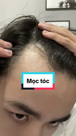 Mình đã bớt hói như thế này, hy vọng bạn vào cuộc sớm khi còn nang tóc #haircare #luongdo #moctoc #Readytosummer #SALEchaohe 