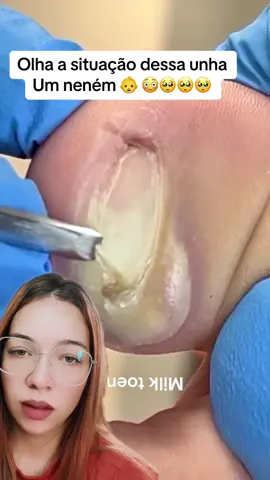 Unha muito encravada #unhas #podologia #unhaencravada #pe #satisfatório 