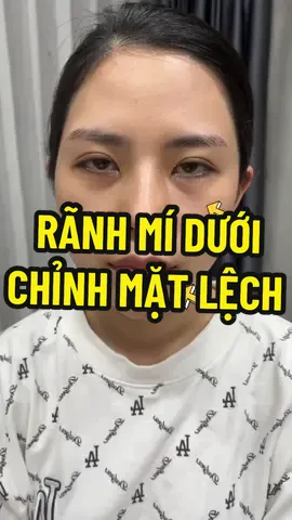 Mày nghĩ sao ???? 🤣🤣🤣 #xuhuong #nganfiller #rãnhmá  #tiêm_cằm 