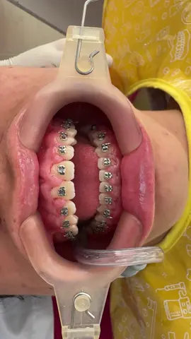 Un minuto de silencio por esta encía 🥺🥺🥹🥹, por favor hacer ortodoncia sobre una encía enferma es un riesgo, aquí hay gingivitis, y agrandamiento gingival a causa de no hacer una buena higiene oral. 🥺🥺🥺🥺 ¡cuidado no es la ortodoncia la que puede “tumbar” tus dientes, tu mala higiene si! 💥  . . . Nunca olvides que tu sonrisa es el espejo de tu alma 🫶 . . . #ortodoncia #encias #gingivitis #enfermedad #dientes 