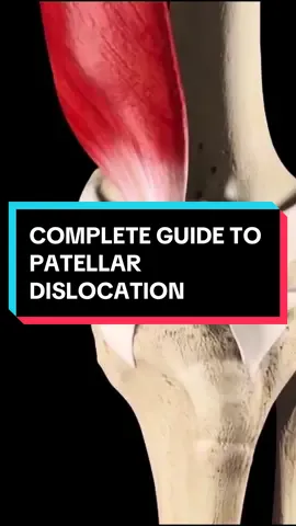 If you’ve recently suffered a patellar dislocation then you NEED to watch this video for a full guide on what rehab might look like! #patellardislocation #patelladislocation #patella #kneepain #patellarpain #kneedislocation #kneepainrelief #kneephysio #kneerehab #fyp #foryoupage #fypシ #fypシ゚viral #physiotherapy #physio #physiostudent #physicaltherapy 
