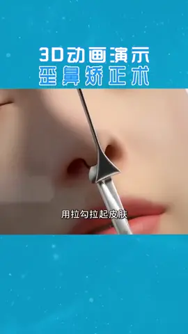 3D动画演示，歪鼻矫正术，deviated nose。#rhinoplasty #鼻综合 #隆鼻 