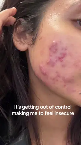 My acne is getting out of control and making me to feel insecure. #acne #acnetreatment #acnescars #cyst #cysticacne #severeacne #face #acnefighter #pimple #folliculitis #acneskin #acneproneskin #fyp #foryou #pain #antibiotics 
