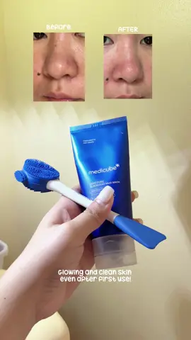 As an acne warrior for a decade now, I can really say mud masks are very helpful with exfoliation and sebum control. Also, blackheads and enlarged pores are not a surprise anymore to acne-prone people like me.  We just have to find the right products for these problems to be managed. 😊 𝓟𝓻𝓸𝓭𝓾𝓬𝓽/𝓼: @medicube_official ZERO PORE BLACKHEAD MUD MASK 𝓗𝓸𝓷𝓮𝓼𝓽 𝓻𝓮𝓿𝓲𝓮𝔀: 💙 feels cooling and tightens as it dries on skin 💙 scent is so yummy!  💙 I love the silicone tool it comes with 💙 travel-friendly packaging 💙 my skin feels clean and supple after use ❕for me you need a lot of product for the whole face and I think 1 tube will get emptied after few uses #medicube #medicubeambassador #medicubezeroporeblackheadmudmask #mudmask #acneprone #oilyskin #kbeauty #koreanskincare #seo  Available on @Amazon  Also available on @OLIVE YOUNG Global & @YesStyle app  🤑5% off code: 𝐌𝐉𝐁𝐋1202 