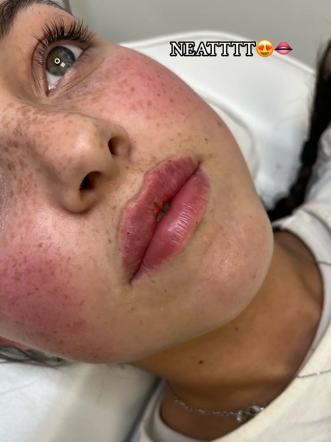 Natural tweaks will always have my heart🥹 #aesthetics #lipfiller #leeds #aesthetic #russianlips #aestheticspractitioner #salon #technique #1ml #botox 