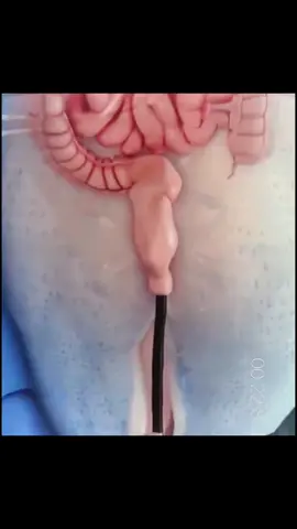 A colonoscopia é um procedimento médico usado para examinar o interior do intestino grosso e parte do intestino delgado, chamado de cólon e reto, respectivamente. Durante a colonoscopia, um médico utiliza um instrumento flexível chamado colonoscópio, que possui uma pequena câmera na ponta, para visualizar o revestimento do cólon em busca de pólipos, inflamação, sangramento ou outras anormalidades. As principais indicações para a realização de uma colonoscopia incluem: Rastreamento de câncer colorretal:  É recomendado para pessoas com mais de 45 anos (ou mais jovens, dependendo do histórico familiar ou de outros fatores de risco) como parte do rastreamento de câncer colorretal. Investigação de sintomas gastrointestinais: Se uma pessoa apresentar sintomas como sangramento retal, dor abdominal, alterações nos hábitos intestinais (como diarreia persistente ou constipação), perda de peso não explicada, entre outros, uma colonoscopia pode ser indicada para determinar a causa. Monitoramento de condições pré-existentes: Pessoas com histórico de pólipos intestinais, doença inflamatória intestinal (como a doença de Crohn ou colite ulcerativa) ou câncer colorretal prévio podem precisar de colonoscopias regulares para monitorar e tratar essas condições. Avaliação de resultados de exames anteriores: Se exames de imagem, como a sigmoidoscopia ou exames de fezes, mostrarem resultados anormais, uma colonoscopia pode ser recomendada para uma avaliação mais detalhada. A colonoscopia é um procedimento seguro, mas pode estar associada a riscos, como perfuração intestinal ou reações adversas à sedação. É importante discutir os benefícios e riscos do procedimento com o médico antes de realizá-lo. #colonoscopia #colonoscopy #ar♿️ #cancerdeintestino #cancer #cancerderecto 