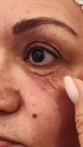 Olha isso gente!👀 O Renova Glow é um tratamento que vai deixar sua pele perfeita! ⚜️✨ Peeling de fenol na região dos olhos!🤌🏻🥰 Agendamentos: (47) 99664-1312 # # # #pele #face #bioestimuladordecolageno #rugasdeexpressao #blumenau #estetica #esteticafacial #colageno #fenol #peelingdefenol @FF 