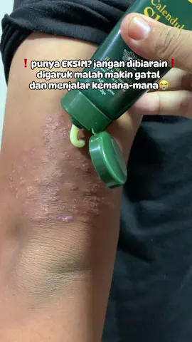 Eksim tuh gatalnya minta ampun ya😮‍💨digaruk makin parah dan menjalar kemana-mana😮‍💨😮‍💨#eksim #eczema #eksimkulit #nearforest #kulitpecahpecah #bekasluka #korengan #pakuan #kulitkering #kulitpecahpecah 
