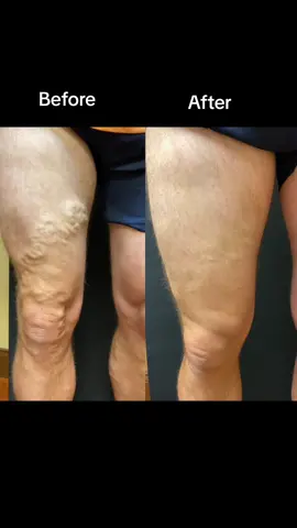 Are you ready for healthy legs that look and feel great?!?!!   Call us at 440-617-6061 or visit NelsonVein.com 24/7 to request a consultation. #nelsonvein #varicoseveins #loveyourlegs #CapCut #beforeandafter 