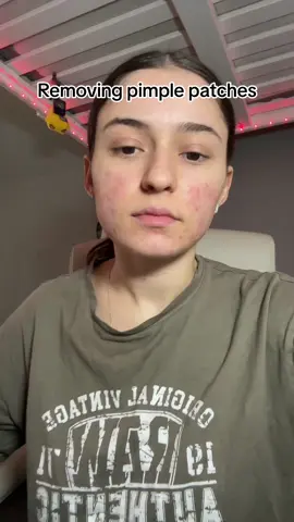 Welll #acne #acneskin #acnescars #acneproneskin #severeacne #acnefighter #cysticacne #acnestruggles #fypシ゚viral #fyp #fy 