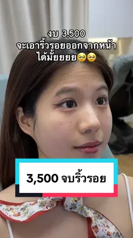 3,500.- เหมาริ้วรอย หน้าผาก หว่างคิ้ว หางตา ราคาเดียวเท่านั้น! #รีวิวบิวตี้ #รีวิวฉีดหน้า #โบริ้วรอย #รีวิวโบท็อก #โบท็อก #หน้าเด็ก #หน้าแก่ #ริ้วรอย #aurabangkokclinic 