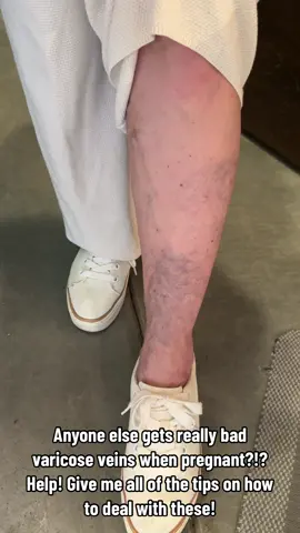 Is it something you struggle with? Let me know if you know if any ways to make these look better cause this is so intense! #pregnancy #pregnant #varicoseveins #veins #expectingmom #momlife #health #MomsofTikTok 