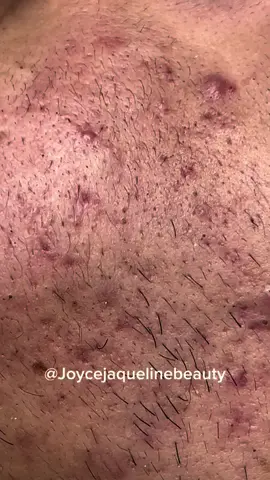 #satisfyingvideo #pimple #esteticafacial #videosatisfatorio #cravo #limpezadepele #poppingpimples 