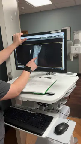 My sons 3rd break in 4 years. Any #orthopedics have a guess? We need to make an appoitment with his ortho dr on monday.  #orthopedicsurgeon #orthopedictechnician  #brokenwrist #growthplateinjury #xray 