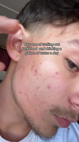 IT SAVED MY SKIN also i have so fucking much energy now. I also switched to panoxyl face wash #fypシ #skincare #acne #GlowUp 