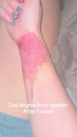 What tattoo should I get? Lol  #fyp #foryou #2nddegreeburn #ouch 