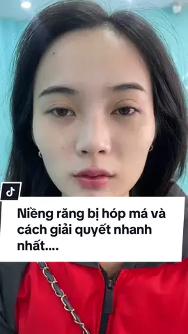 Bé khách niềng răng bị hóp má và sau khi tiêm má xong… #xuhuong #filler #LearnOnTikTok #vinguyenbeauty #fyb #lamdep #xuhuong2024 #tiemma 