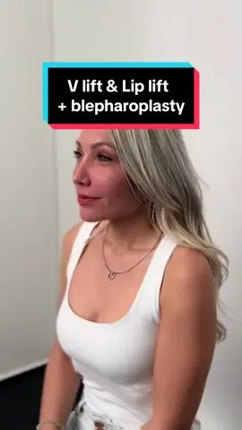 2 months after V lift, Lip lift and blepharoplasty😍 What do you think? All done in local anesthesia💪🏻 📲 If you want to make an appointment, contact us at info@v-clinic.cz #facelift #vlift #liplift #blepharoplasty #plasticsurgery #plasticsurgeon #plastickachirurgie #ventruba #vclinic #transformation #beforeandafter 