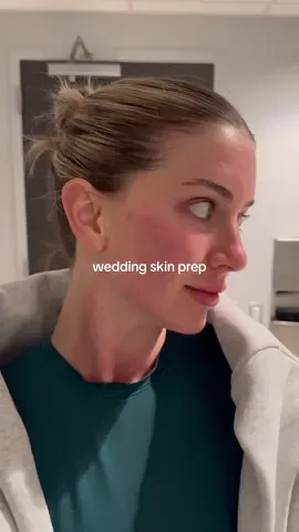 getting mirconeedling with PRP and BBL photofacial to help with my acne scarring!! #acnescars #microneedling #skintreatment 