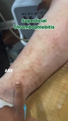 Blood clots are a complication of untreated vein disease.  Some blood clots are more dangerous than others.  This is an example of superficial thrombophlebitis, a condition where a blood clot forms in a vein just below the surface of the skin.  Superficial thrombophlebitis typically causes pain, swelling, redness, and warmth along the affected vein just like you see here.  Treatment often involves relief of the symptoms with pain relief, anti-inflammatory medication, and occasionally, blood thinners.  If the blood clot stays in the superficial varicosities, then patients typically do not need blood thinners, but they do need close follow up.   These clots can continue to irritate other veins causing more veins to clot.  The closer these superficial clots come toward your deep veins, the more dangerous and life-threatening they can be.   A repeat ultrasound should be scheduled, and if the patient notices more redness, pain, and hard veins approaching the thigh, groin, or behind the knee with worsening of their symptoms a few days after their initial presentation, then another ultrasound should be done immediately in order to make sure that the clot has not entered the saphenous vein or the deep veins.   Once these veins are clotted and they have hardened, removing them is no longer a good option.  The body may absorb the vein leaving the skin dark and hardened.   Approximately 9% of the time, superficial thrombophlebitis can directly lead to a pulmonary embolus which is a blood clot in the lung.  Any signs of chest pain or shortness of breath require a call for an ambulance and emergency services.  If the entire leg begins to swell, then this is a sign that the clot may have extended into the deep vein and now the clot has blocked all of the blood from leaving the leg.  This also requires emergency evaluation.   Treating varicose veins before they clot is key to health.  Call Nelson Vein at (440) 617-6061 or visit NelsonVein.com 24/7 to request a consultation for healthy legs that look and feel great.   #nelsonvein #varicoseveins #microphlebectomy #loveyourlegs #bloodclots #superficialthrombophlebitis #dvt #pulmonaryembolism #pe @VeinGirl/Varicose Veins 