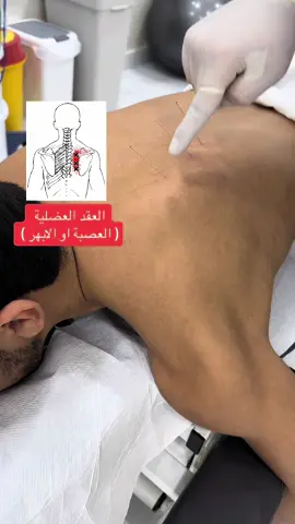 ألام منتصف الظهر العصبة او الابهر نفكها بتقنية الابر الجافة  موقعنا الدوحة - قطر 🇶🇦 رقم  التواصل وتس  50186516  رقم العيادة 44353944  . . . . . . . #qatar #qatar🇶🇦 #qatartiktok #doha #dogsoftiktok #dohaqatar🇶🇦  #قطر #قطر🇶🇦 