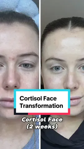 Day 1 to day 16!  What a difference!!  My skin and inflammation has gotten SO much better!  I always used to struggle with ‘moon face’ or cortisol face…basically where you’re stressed and hold a ton of water in your face!  As a result, the cheeks are CHEEKING and can also result in Acne too!  Yes this A.I.P diet has not been easily, but it’s been very manageable and I’m not at all dressing the next few weeks. In fact, I’m BEYOND excited to see what results I’ll see next.  In 10 years I’ve struggled with my Endo, these past 2 weeks have been the easiest of my life …so roll on day 17  #AIPdiet #Antiinflammatorydiet  #autoimmunediet #endometriosissymptoms  #endometriosisdiet  #endobelly #cortisol  #cortisolface #moonface  @Endometriosis | Endo Spectrum 