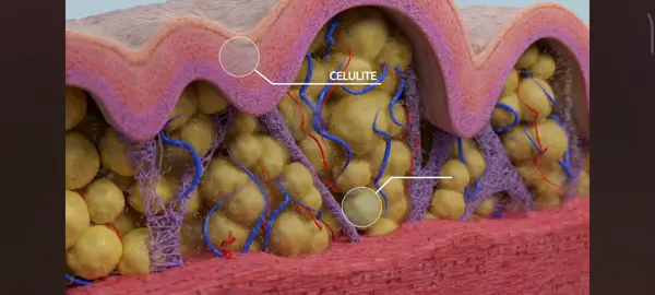 Como é feito a SUBCISÃO??? É através de uma cânula bisturizada que vai rompendo as fibroses no tecido.  #zerocelulite #celulitezero #pelelinda #pelelisa 