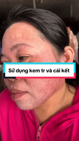 Chị khách hà tiên dùng kem chọn và cái kết, lúc đầu rất đẹp sau là ố zề lun đó mn #kemtron #spa #nám #tiktokawardsvn2023 