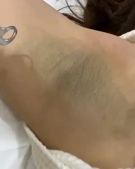 ƯU ĐÃI THÁNG 5 - LASER XÓA THÂM NÁCH CHỈ 139K Xóa thâm nách công nghệ Laser mới nhất 2024: ⭐Đón mùa hè năng động với VÙNG NÁCH sáng mịn sạch thâm.  ⭐Thêm điểm cộng cho thần thái, tự tin trong mọi khoảnh khắc.  Khử sạch thâm nách – Bật sắc trẻ trung  🎁 Nhận ưu đãi khủng giá gốc 2.000.000đ giảm còn 139.000đ  Công nghệ độc quyền Mỹ - Cam kết hiệu quả bằng văn bản ________________ 🏥 Hệ Thống Phòng Khám Chuyên Khoa Da Liễu Klaire  GPHĐ Khám chữa bệnh số : 3416/HNO - GPHĐ * Địa chỉ: số 304 đường Quang Trung, phường La Khê, TP. Hà Nội * Hotline: 0836199979 * Website: www.klaireclinic.vn * Fanpage: Phòng khám chuyên khoa da liễu Klaire