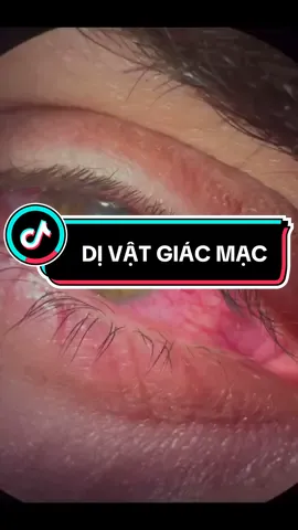 Dị vật giác mạc | Một trong những chấn thương Mắt thường gặp trong sinh hoạt và cuộc sống  #CapCut #doctor #eyes #ophthalmology #medicine #humanbody #Science #trauma 