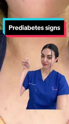 Prediabetes, or borderline diabetes, is when your blood sugar level is higher than it should be but not high enough for your doctor to diagnose diabetes.People with type 2 diabetes almost always have prediabetes first. #diabetes #sugar #darkcircles #hyperpigmentation #acne #bloodsugar #hyperglycaemia #diabetic #diabetestype1 #diabetestype2 #pcos #health #skincare #foryou #foryoupage #fyp 