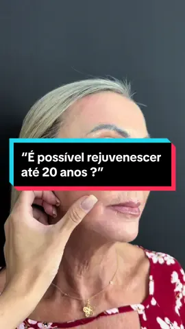 A ciência e tecnologia são capazes de fazer tudo! 🧚✨  #rejuvenescimento #procedimentosesteticos #harmonizacaofacial #antesedepois #TratamentosEstéticos #CuidadosComAPele 