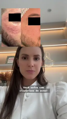 Como melhorar as cicatrizes de acne!                      #dermatologist #acne #tratamentoacne #dicasdermatologicas #roacutan #luzpulsada #profhilo #laserablativo 