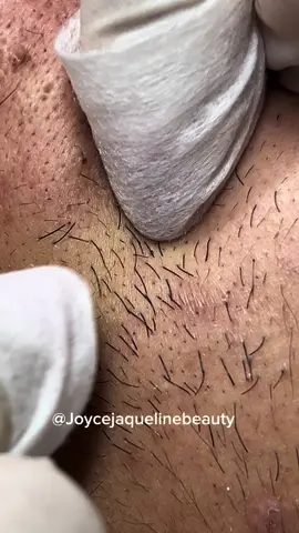 #satisfyingvideo #pimple #esteticafacial #videosatisfatorio #limpezadepele #cravo #cravolovers #poppingpimples #fy 