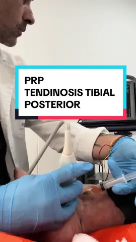⚠️Factores de crecimiento para tendinosis del tendón del tibial posterior. #biomecanica #tibialposterior #tendinosis #especialistasenpie