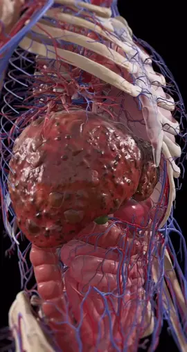 Kỹ thuật siêu âm đàn hồi mô gan là phương pháp chẩn đoán không xâm lấn, mang đến độ chính xác cao, khắc phục được những nhược điểm của sinh thiết trong xác định xơ hóa gan. Hiện nay, siêu âm đàn hồi mô gan là giải pháp hữu hiệu giúp xác định xơ hóa gan chính xác nhất với những ưu điểm tuyệt vời như: Dễ thực hiện, không xâm lấn, có thể lặp lại, độ chính xác cao. #bacsi #namkhoa #suckhoe #tiktok #IF #xuhuong 