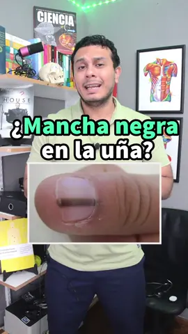 Manchas negras en la uña Este video tiene la intención de enseñar a la gente a reconocer cuando una mancha es normal y cuando no, detectar a tiempo una mancha rara en una uña que pudiera ser un MELANOMA puede salvar muchas vidas, no olvides compartir el video 😇 #manchanegraenlauña #melanoma #salud #medicina #longervideos 