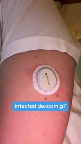 ugh, i always wish we’d receive one extra instead of the exact amount needed for the month 🤦🏼‍♀️😭 one failed sensor and your screwed for sometimes over a week #dexcomg7  #infection #t1dmom #t1diabetes 