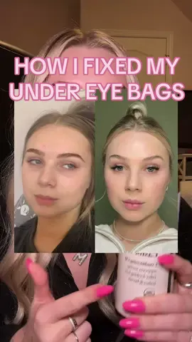 how i fixed my dark circles/ under eyes with castor oil 👁️👄👁️ #darkcircles #undereyebags #castoroil 