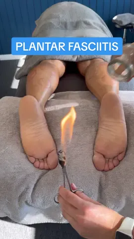 PLANTAR FASCIITIS😖🔥 #osteo #osteopath #staystrongosteo #plantarfasciitis #footpain #feetcare #feet #heelpain #cupping