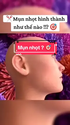 Mụn nhọt không khó để có thể điều trị nên bạn có thể điều trị mụn nhọt tại nhà, tuy nhiên nếu không biết chữa trị đúng cách thì sẽ để lại những hậu quả như mủ bị vỡ sớm, vết thâm lưu lại khó phai. #bacsi #thammy #suckhoe #ykhoa #xuhuong2024 #IF 