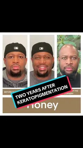 TWO YEARS UPDATE. #HONEY #keratopigmentation #kerato_nyc_safe_eye_color_change  #doctormovshovich #kerato #ophthalmology #medicine  #eyedoctor #eye  #eyecolorchange  #safeeyecolorchange  #beauty #permanenteyecolorchange #cosmeticsurgery #plasticsurgery #beforeandafter #eyejob #neweyes #newiris #testimony #keratopigmentationtestimony #surgery #keratonyc #newyork #manhattan 