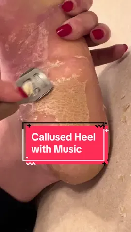 Hope you enjoy the music 🥰 #parmeseanpalms #callusremoval 