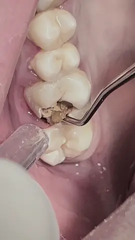 Dental clinic collection scaling and cleaning tooth brushing teeth keep you safe #dentist #dentista #teeth #chicago 