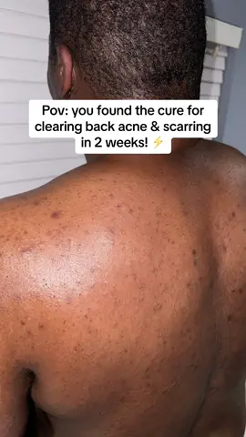 The only way to clear your back & fade acne scarring at home!⚡️✨ #foryoupage #foryou #trending #acne #acneskin #skin #skincare #clearskin #desi #hyperpigmentationtreatment 