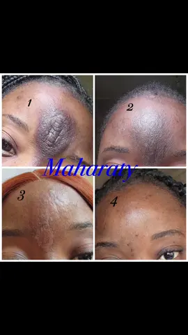 So Ndiye so 💃🏼💃🏼 @Maharaty Mediherb Northmead  Scar treatment pa Maharaty Mediherb This is the same treatment that works to fade stretchmarks, black spots and hyperpigmentation. Consultation is k100 everything else is charged after we see and examine. Northmead branch now reopened 📌Thanks for the feedback hun🙏🏽 Your health beauty and wellness is our priority 💙💚🤍 #Laserspa #Scarremoval #steetchmarksremoval #blackspotsremoval