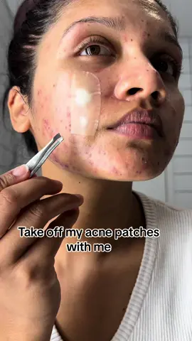 Peel off #pimplepatch  #acne #cyst #pimplepatch #pimplepatches #hydrocolloidpatches #hydrocolloidbandages #hydrocolloid #acneproneskin #acneskin #acnepositivity #cysticacne #cystpopping #acnetreatment #cystremoval 
