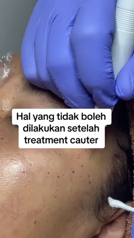 Harus banget pake sunscreen dan sering di aply☺️#treatmentcauter #lasercauter #cautermilia #cautertahilalat #cauterkeratosis #shanizskincare #shanizbeautycare #pantangansetelahcauter 