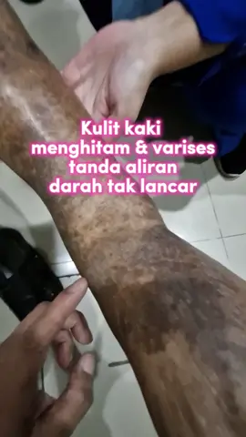 #varises #gagal #jantung #rsbudiasihcikarang #umur #tua #mindset #motivasi #CapCut 